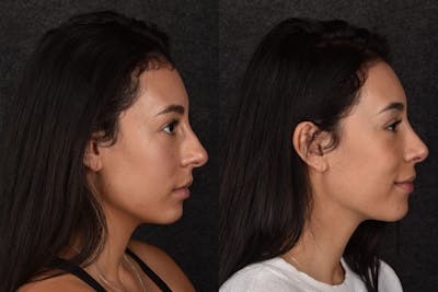 Rhinoplasty Before & After Gallery - Patient 373726 - Image 1