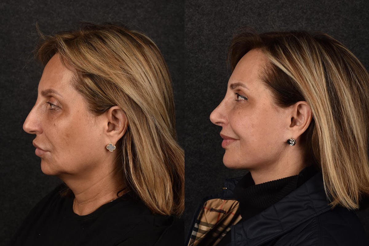 Lip Lift Before & After Gallery - Patient 237342 - Image 1