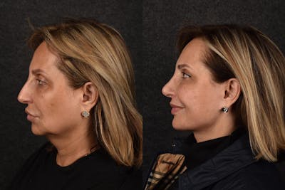 Deep Plane Facelift Before & After Gallery - Patient 266831 - Image 1