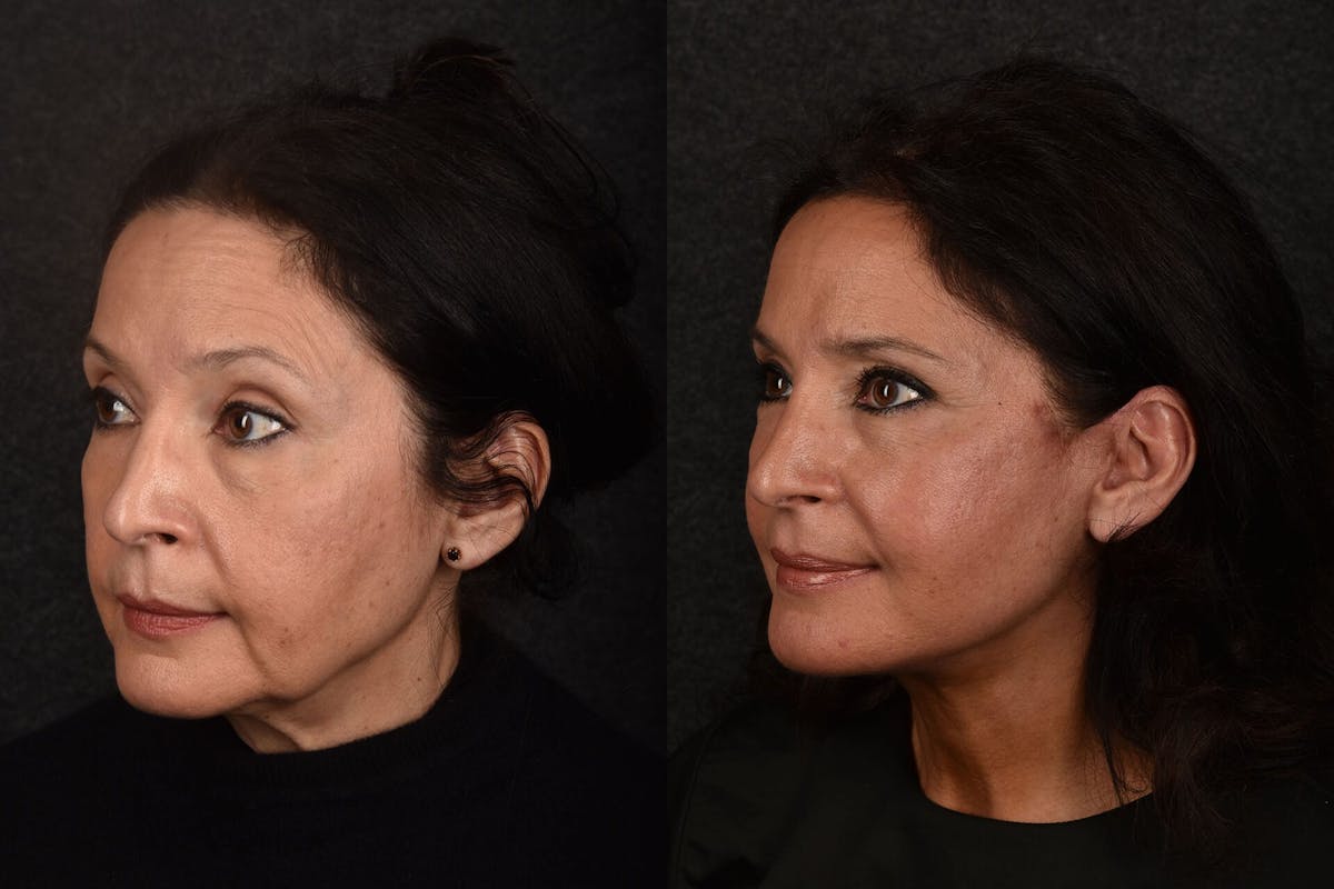 Facial Rejuvenation Before & After Gallery - Patient 339304 - Image 1