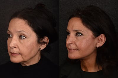 Deep Plane Facelift Before & After Gallery - Patient 343925 - Image 1