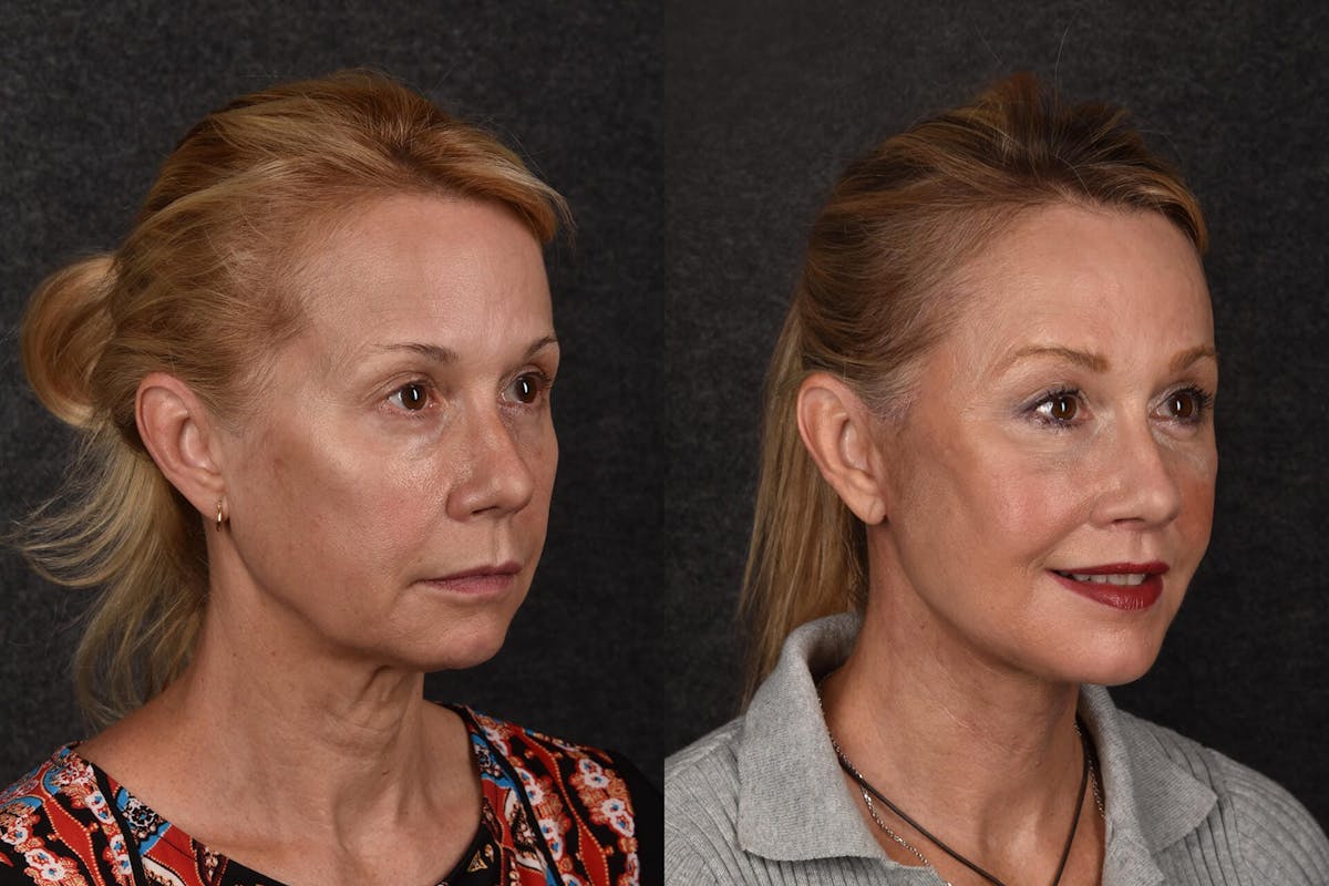 Brow Lift Before & After Gallery - Patient 138832 - Image 1