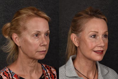 Deep Plane Facelift Before & After Gallery - Patient 112944 - Image 1