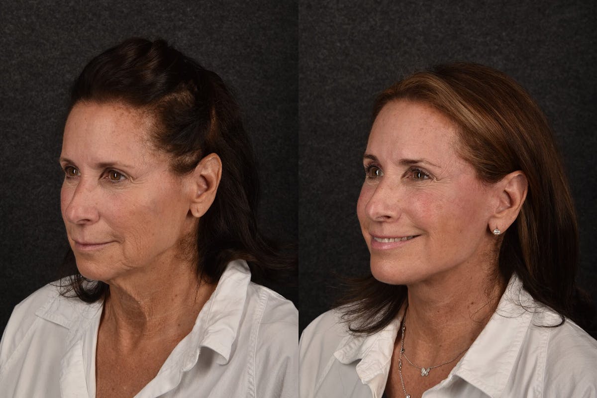 Deep Plane Facelift Before & After Gallery - Patient 102448 - Image 1