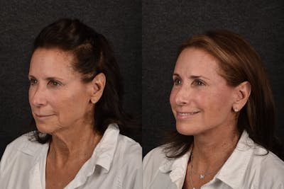 Deep Plane Facelift Before & After Gallery - Patient 102448 - Image 1