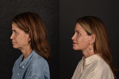 Deep Plane Facelift Before & After Gallery - Patient 246623 - Image 1