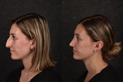 Rhinoplasty Before & After Gallery - Patient 371327 - Image 1