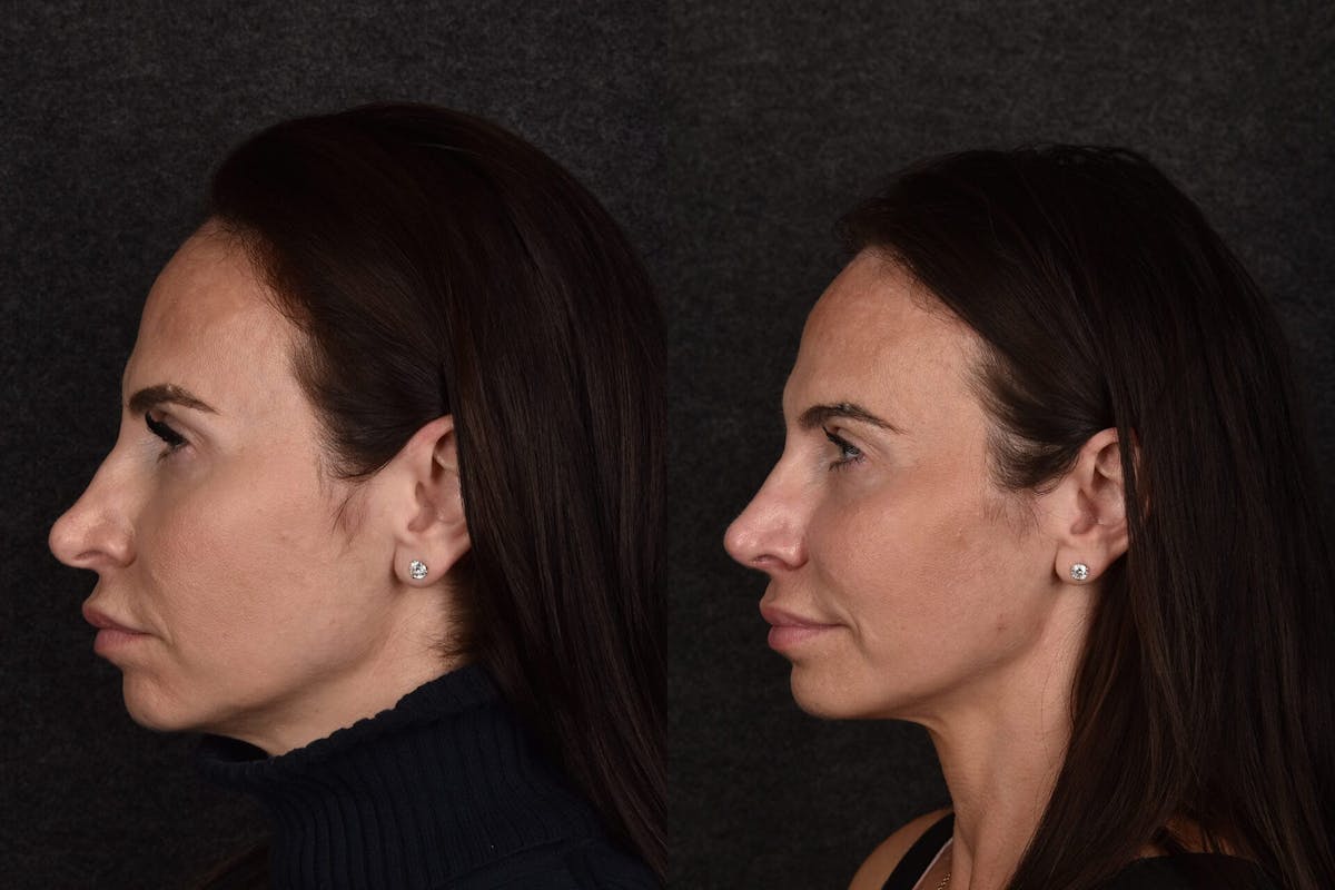 Rhinoplasty Before & After Gallery - Patient 171124 - Image 1