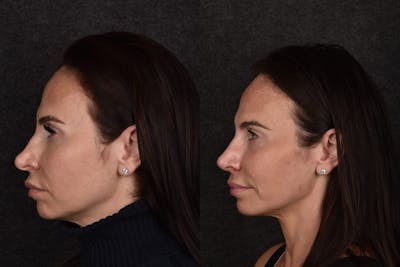 Rhinoplasty Before & After Gallery - Patient 171124 - Image 1