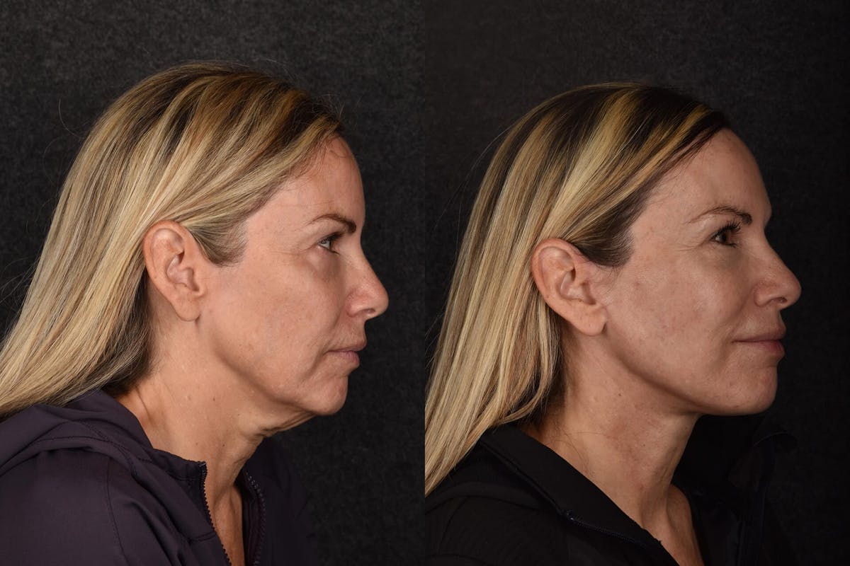 Blepharoplasty Before & After Gallery - Patient 257538 - Image 1