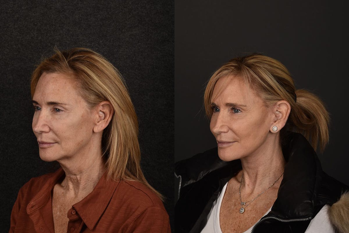 Deep Plane Facelift Before & After Gallery - Patient 869406 - Image 1