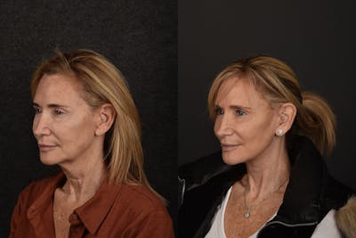 Deep Plane Facelift Before & After Gallery - Patient 869406 - Image 1