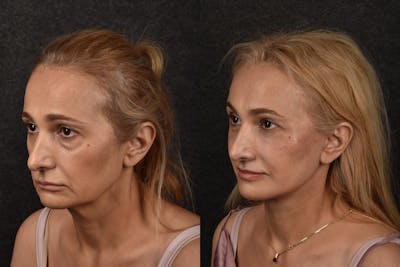 Deep Plane Facelift Before & After Gallery - Patient 296396 - Image 1