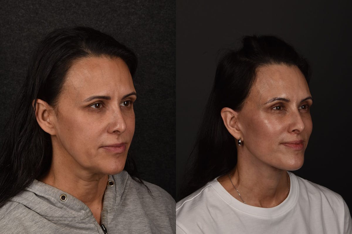 Lip Lift Before & After Gallery - Patient 357507 - Image 1