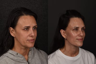 Deep Plane Facelift Before & After Gallery - Patient 158034 - Image 1