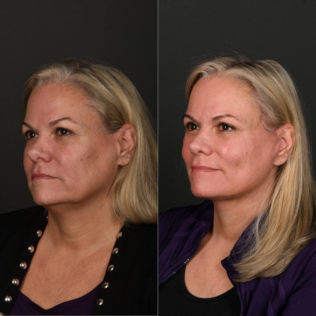 Rhinoplasty Before & After Gallery - Patient 249913 - Image 1