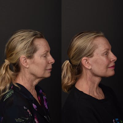 Lip Lift Before & After Gallery - Patient 122292 - Image 1