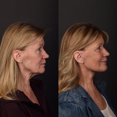 Deep Plane Facelift Before & After Gallery - Patient 281172 - Image 1