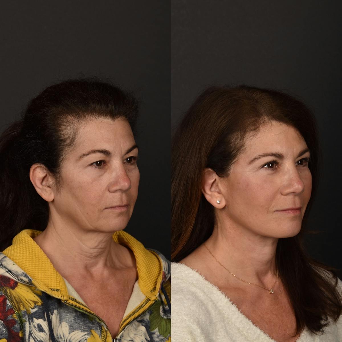 Deep Plane Facelift Before & After Gallery - Patient 284002 - Image 1