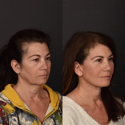 Deep Plane Facelift Before & After Gallery - Patient 284002 - Image 1