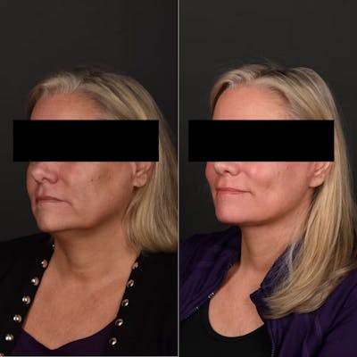 Deep Plane Facelift Before & After Gallery - Patient 294451 - Image 1