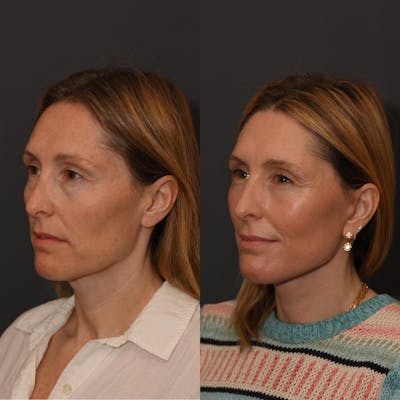 Facial Rejuvenation Before & After Gallery - Patient 285566 - Image 1