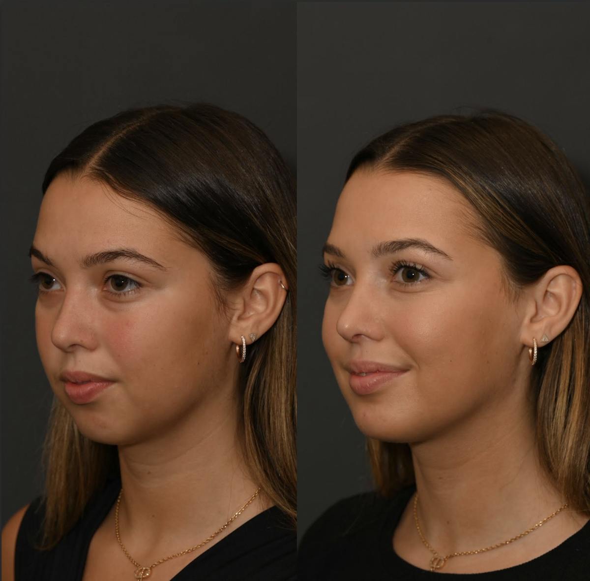 Chin Augmentation Before & After Gallery - Patient 289535 - Image 1