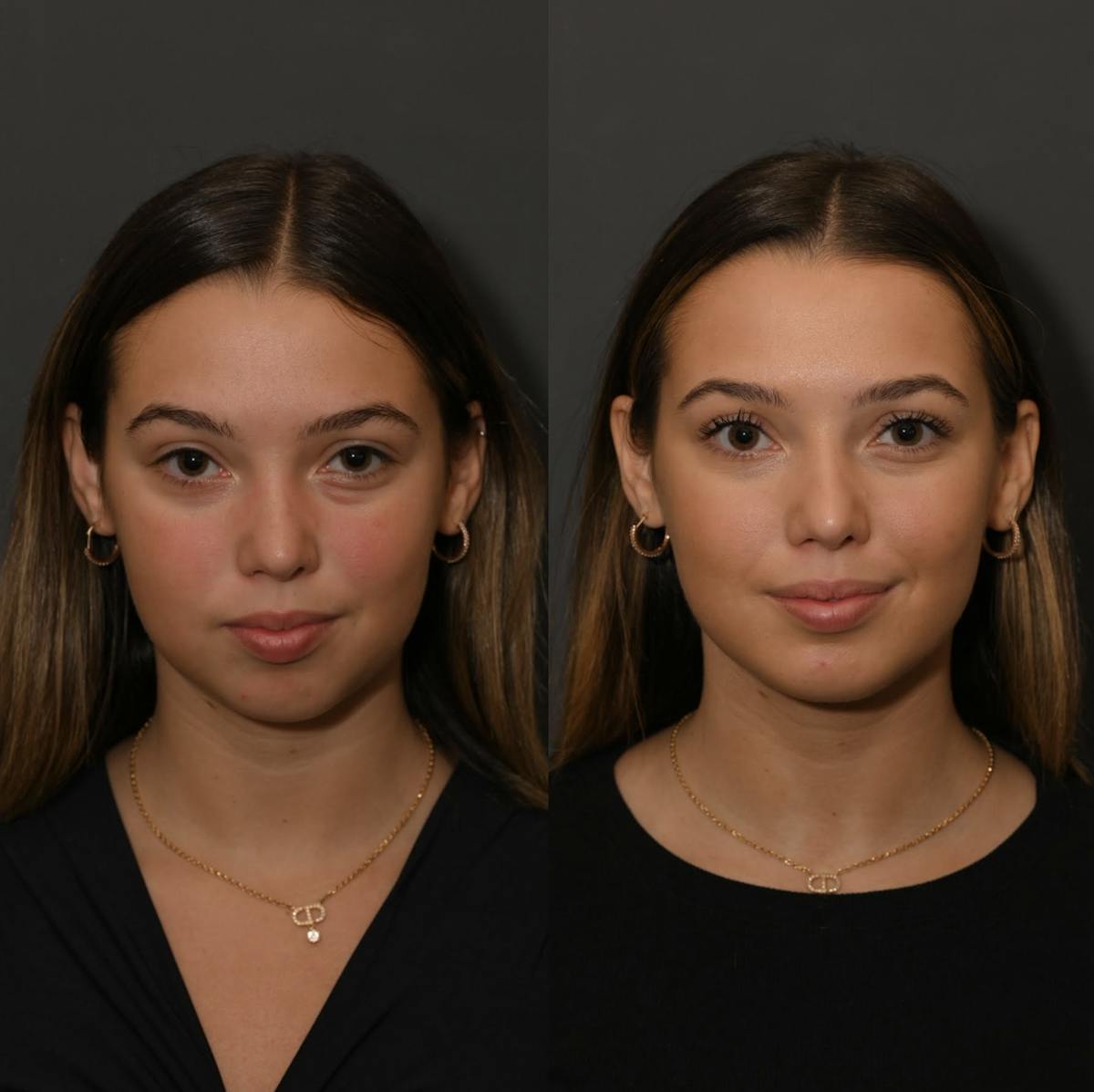 Chin Augmentation Before & After Gallery - Patient 289535 - Image 3