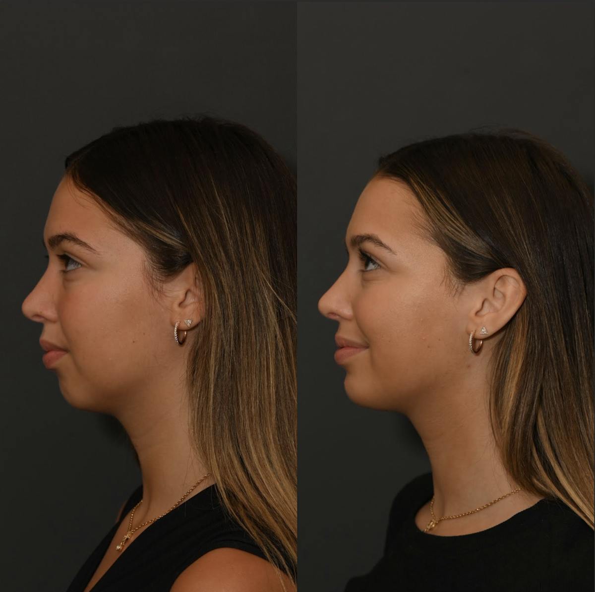 Chin Augmentation Before & After Gallery - Patient 289535 - Image 2