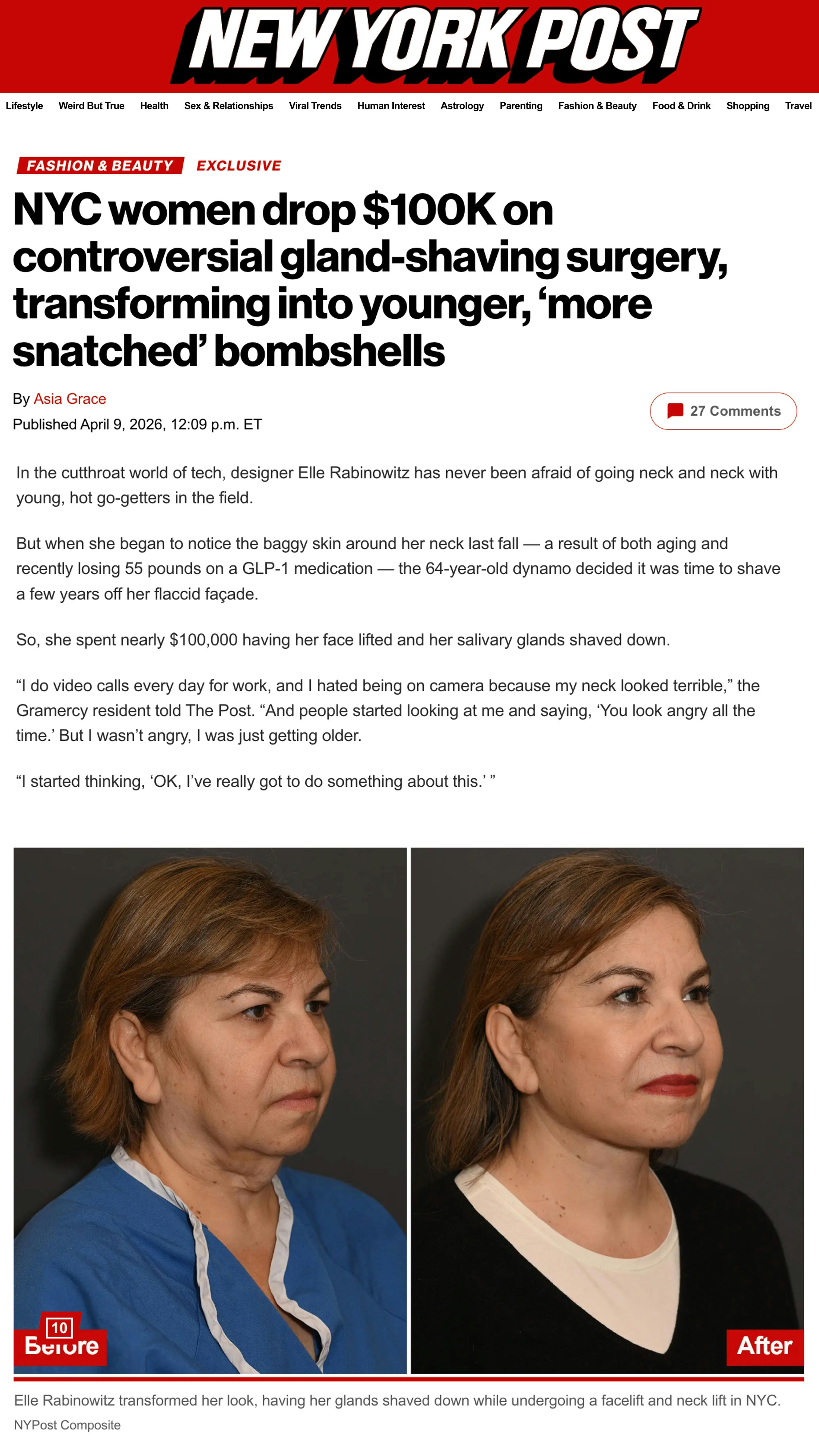 NYC women drop $100K on controversial gland-shaving surgery, transforming into younger, 'more snatched' bombshells