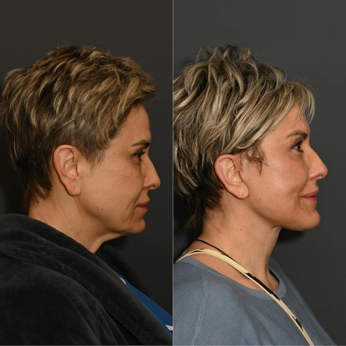 Deep Plane Facelift Before & After Gallery - Patient 336947 - Image 1