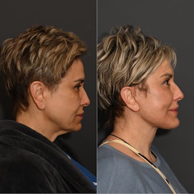 Deep Plane Facelift Before & After Gallery - Patient 336947 - Image 1
