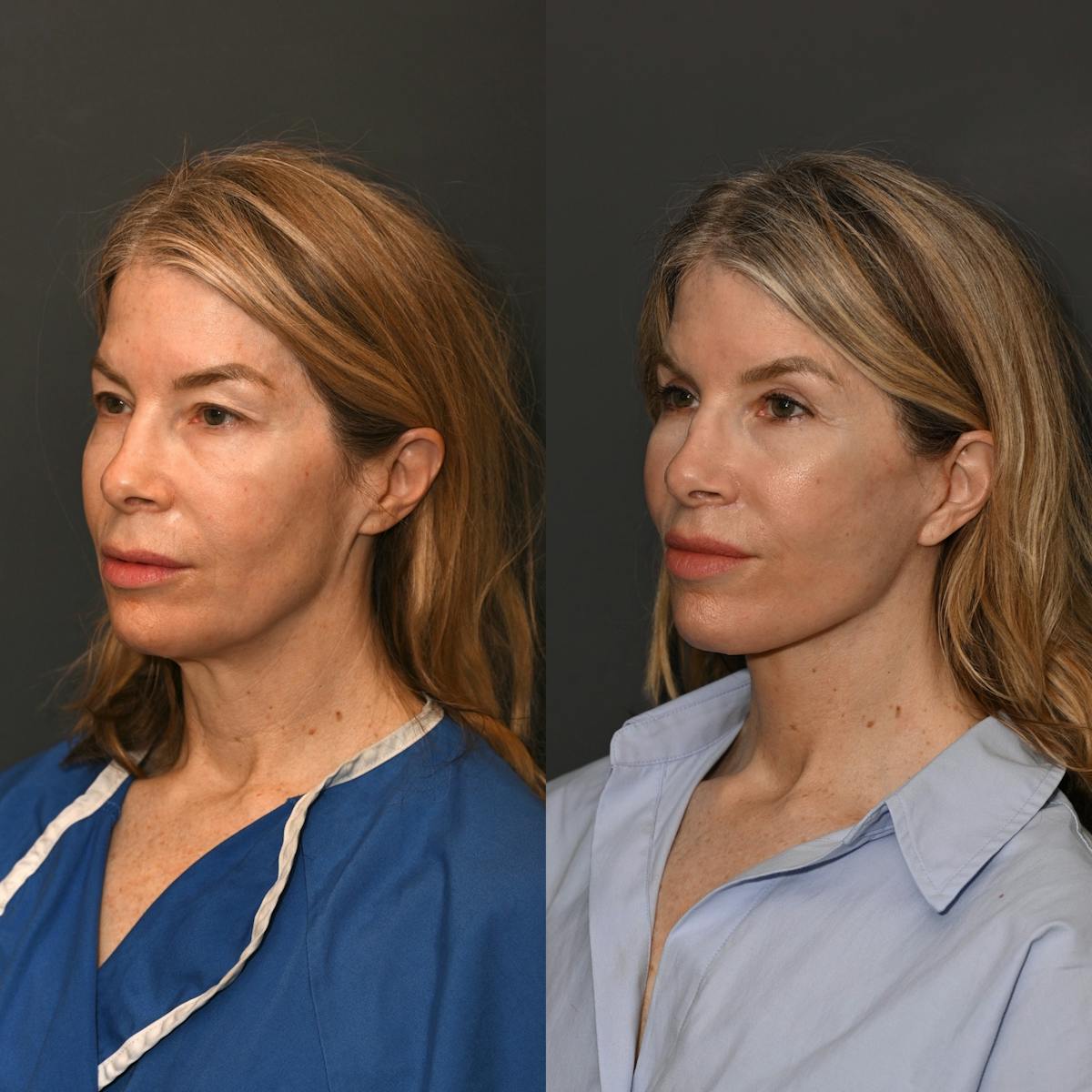 Deep Plane Facelift Before & After Gallery - Patient 316319 - Image 1