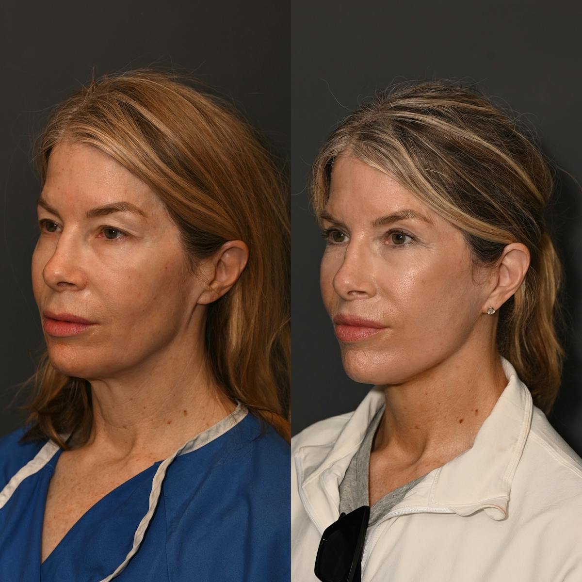 CO2 Laser Treatment Before & After Gallery - Patient 180535 - Image 1