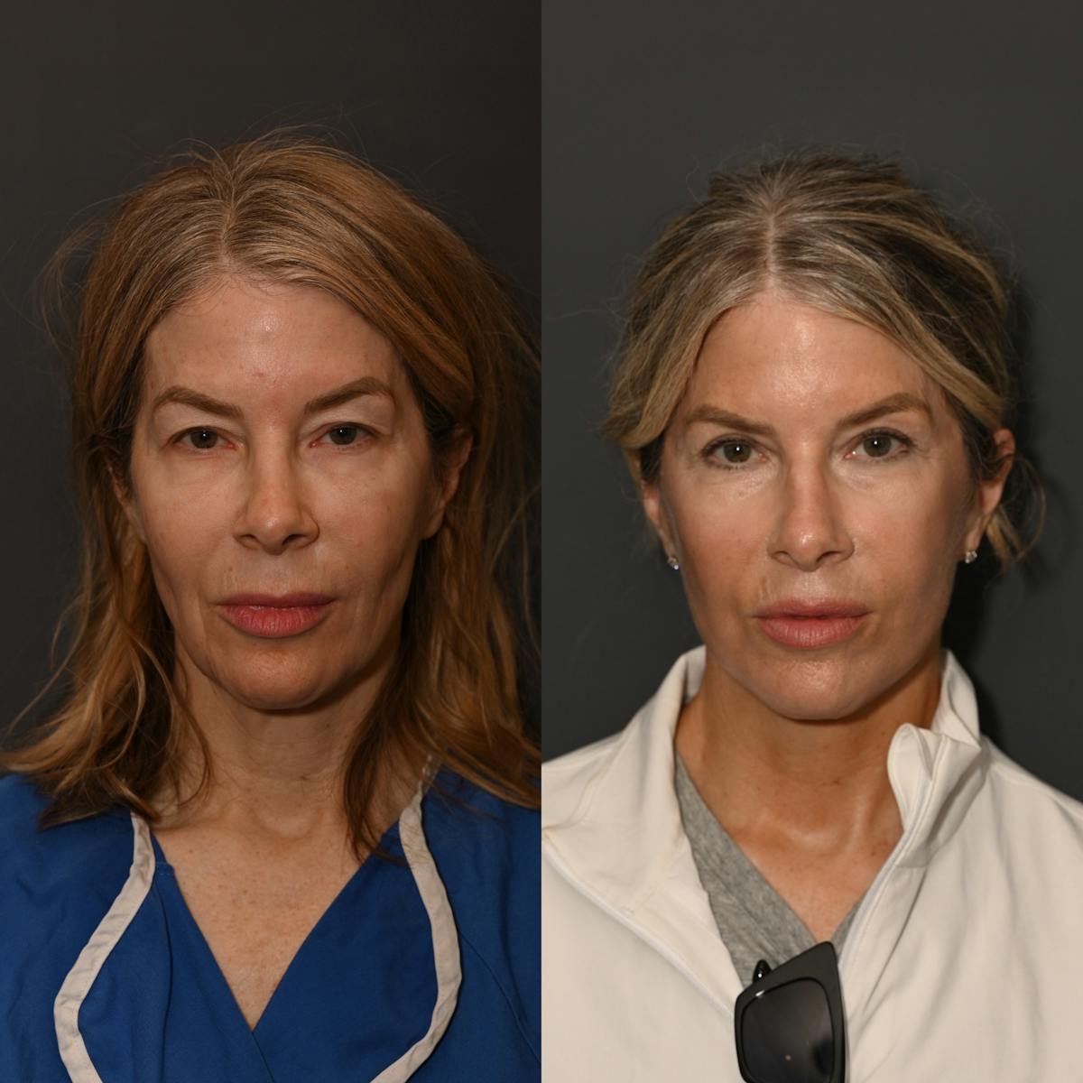 CO2 Laser Treatment Before & After Gallery - Patient 180535 - Image 2