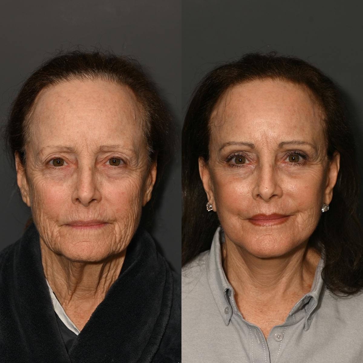 Brow Lift Before & After Gallery - Patient 347134 - Image 2