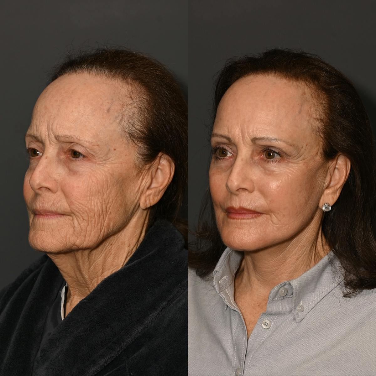 Brow Lift Before & After Gallery - Patient 347134 - Image 1