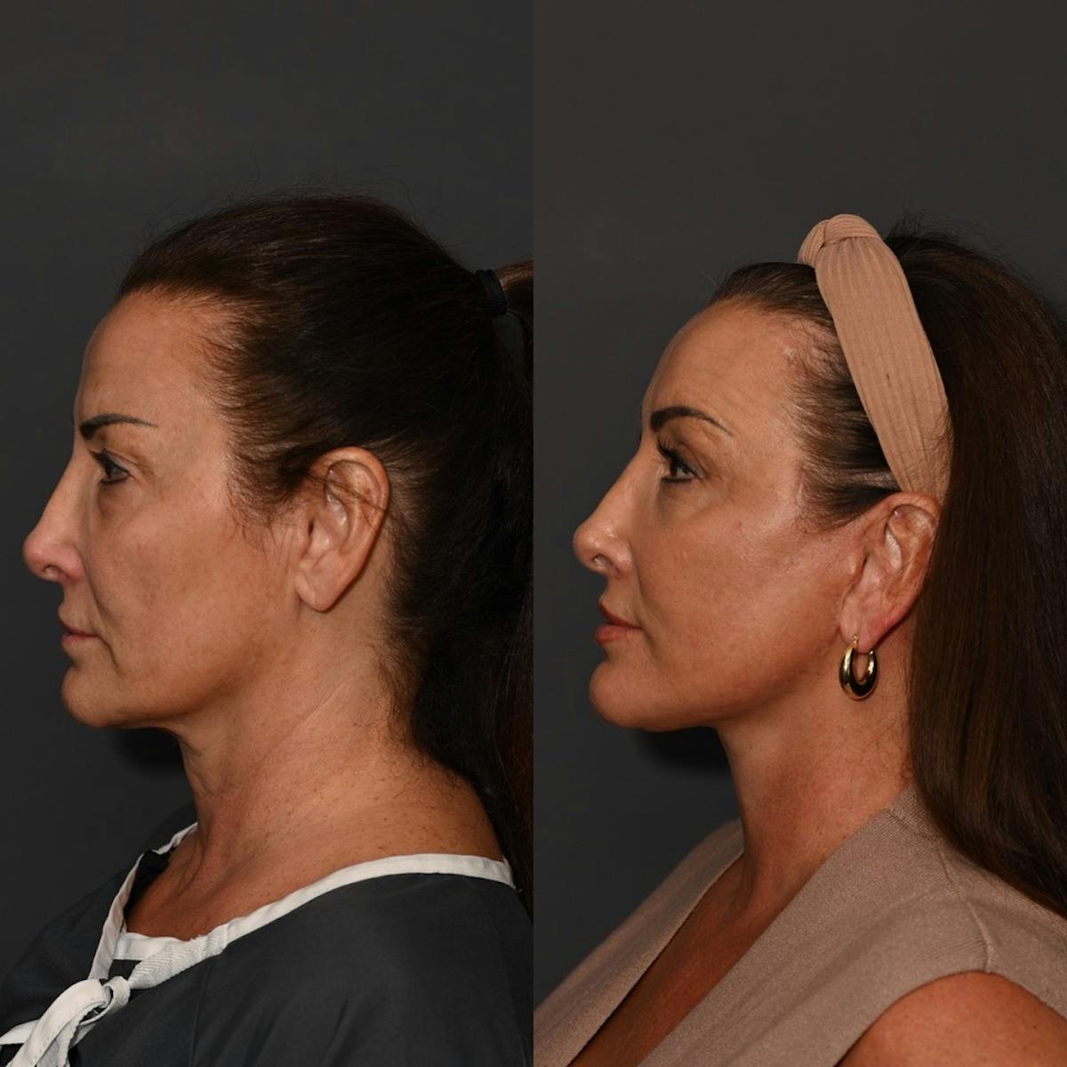 CO2 Laser Treatment Before & After Gallery - Patient 366696 - Image 2