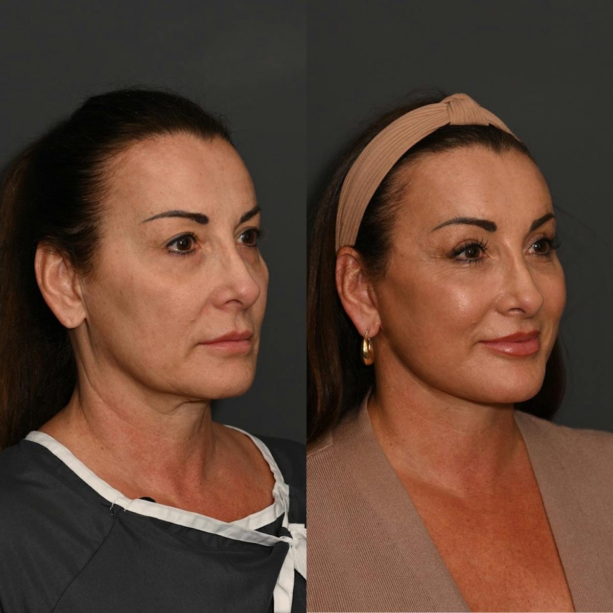 CO2 Laser Treatment Before & After Gallery - Patient 366696 - Image 3