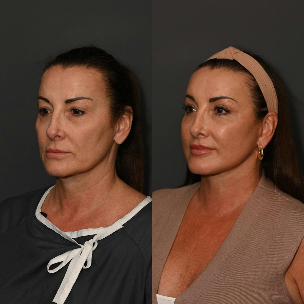 CO2 Laser Treatment Before & After Gallery - Patient 366696 - Image 1