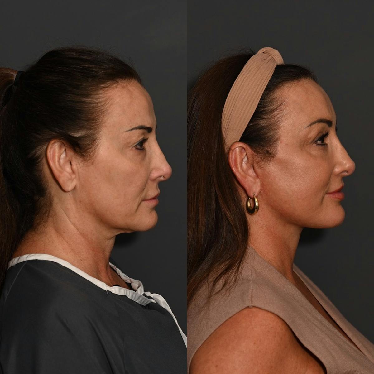 CO2 Laser Treatment Before & After Gallery - Patient 366696 - Image 4