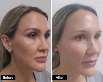 Dermal Fillers Before & After Gallery - Patient 418020 - Image 1