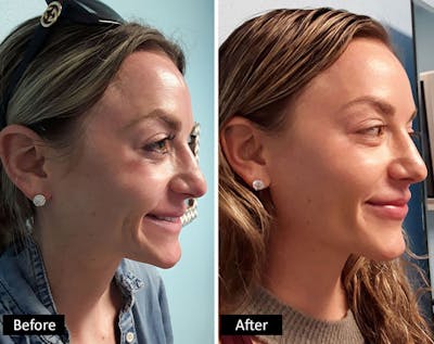 Dermal Fillers Before & After Gallery - Patient 320430 - Image 1
