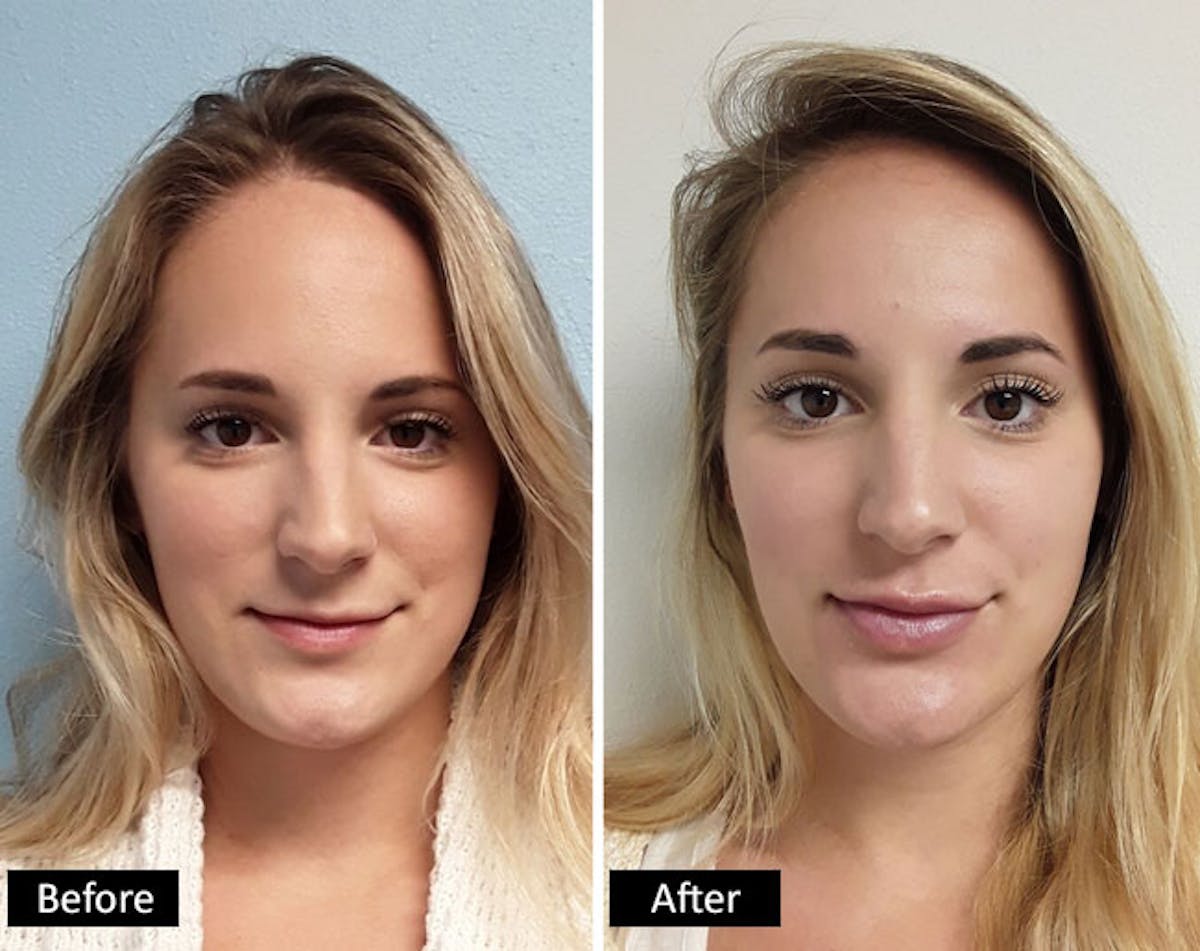 Dermal Fillers Before & After Gallery - Patient 576962 - Image 1