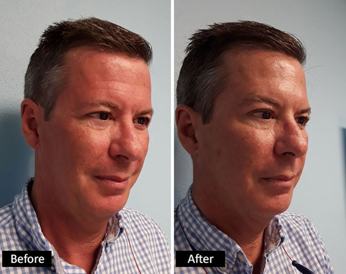 BOTOX & Dysport Before & After Gallery - Patient 260129 - Image 1