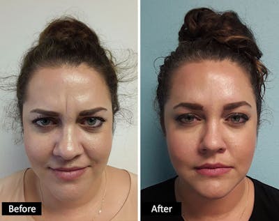 BOTOX & Dysport Before & After Gallery - Patient 254459 - Image 1