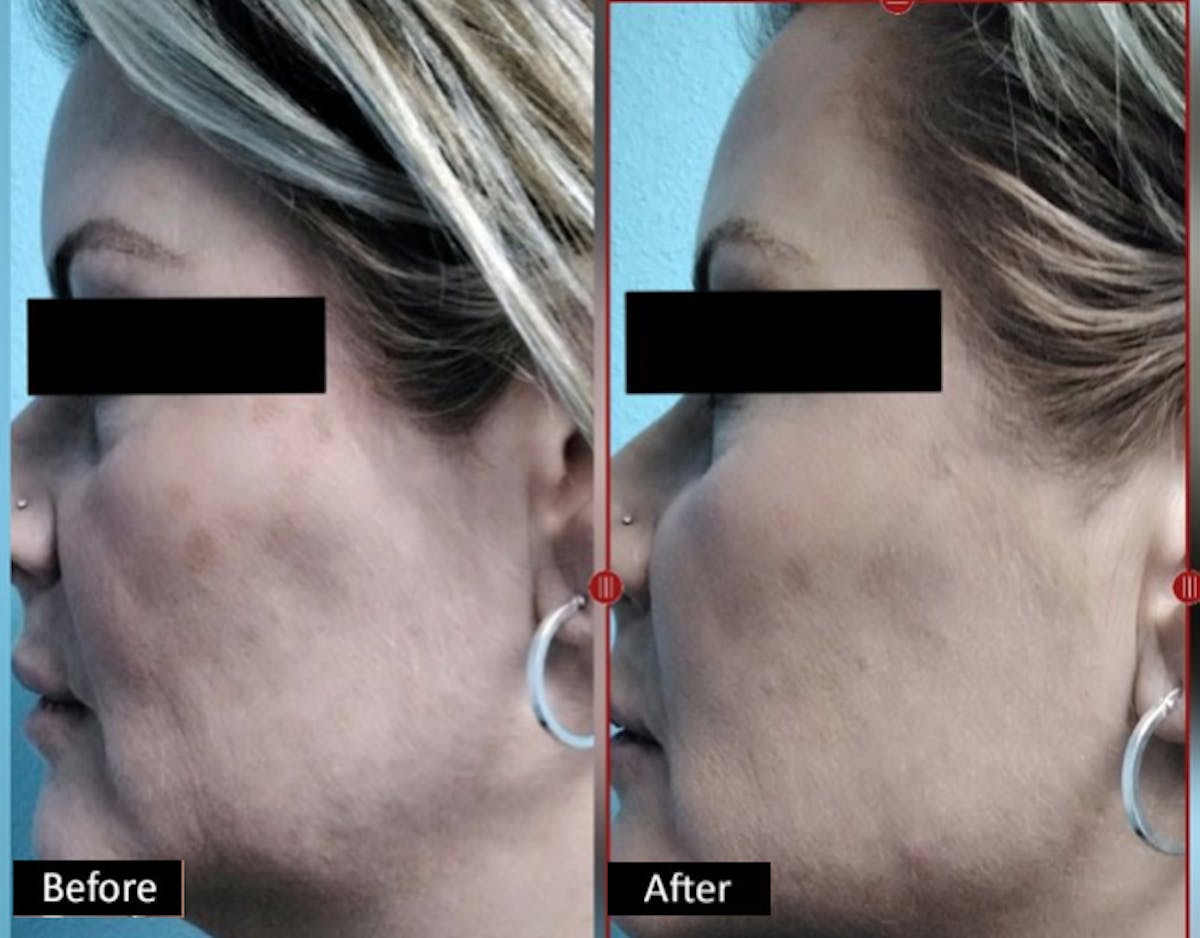 Nefertiti Lift Before & After Gallery - Patient 402002 - Image 1