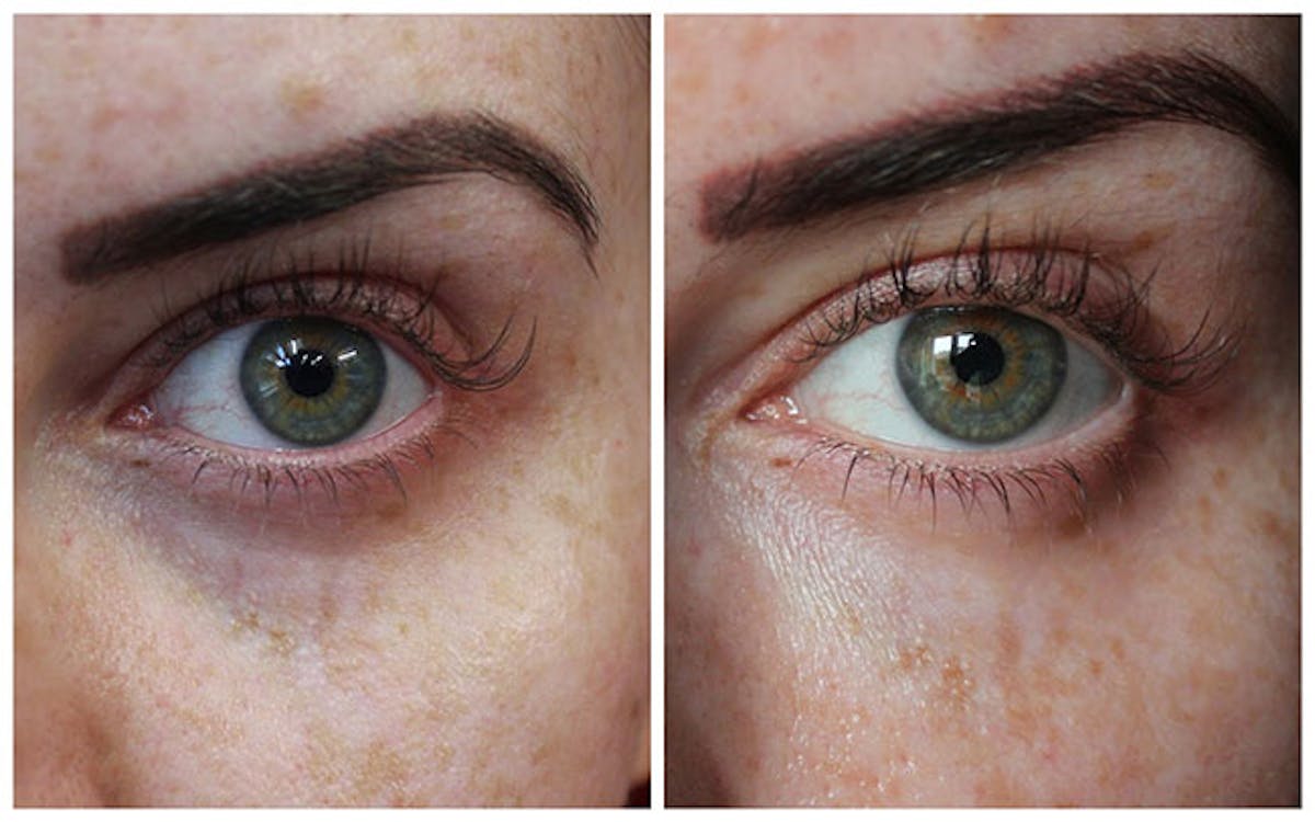 Tear Trough Before & After Gallery - Patient 216307 - Image 1