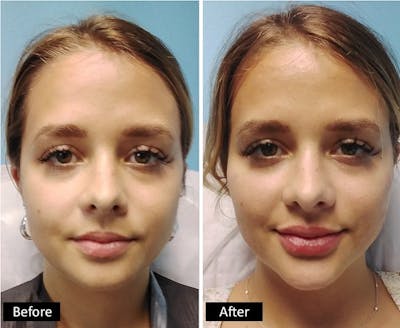 Cheeks & Lips Before & After Gallery - Patient 288342 - Image 1