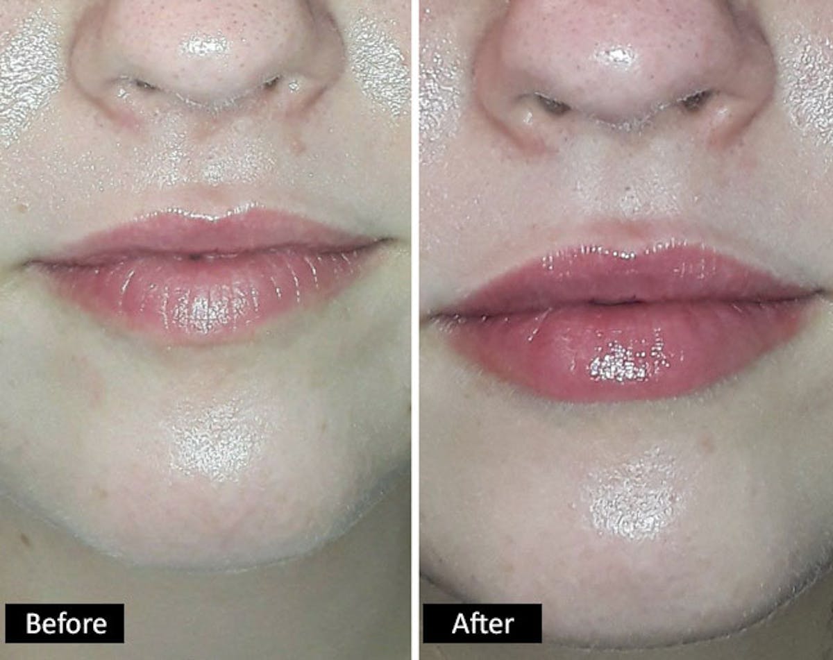 Lips & Chin Before & After Gallery - Patient 153548 - Image 1